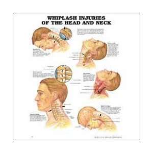  Whiplash Injuries of the Head and Neck Anatomical Chart 